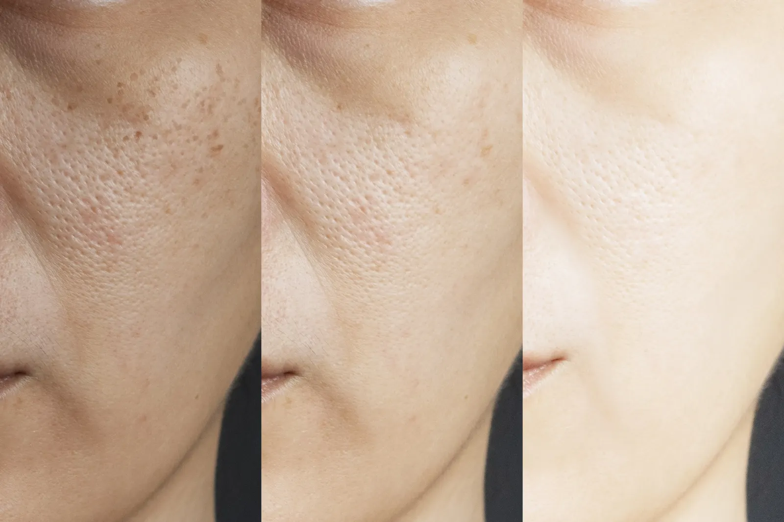 Three-stage close-up showing facial skin brightening and clearing, the glow from a glutathione boost