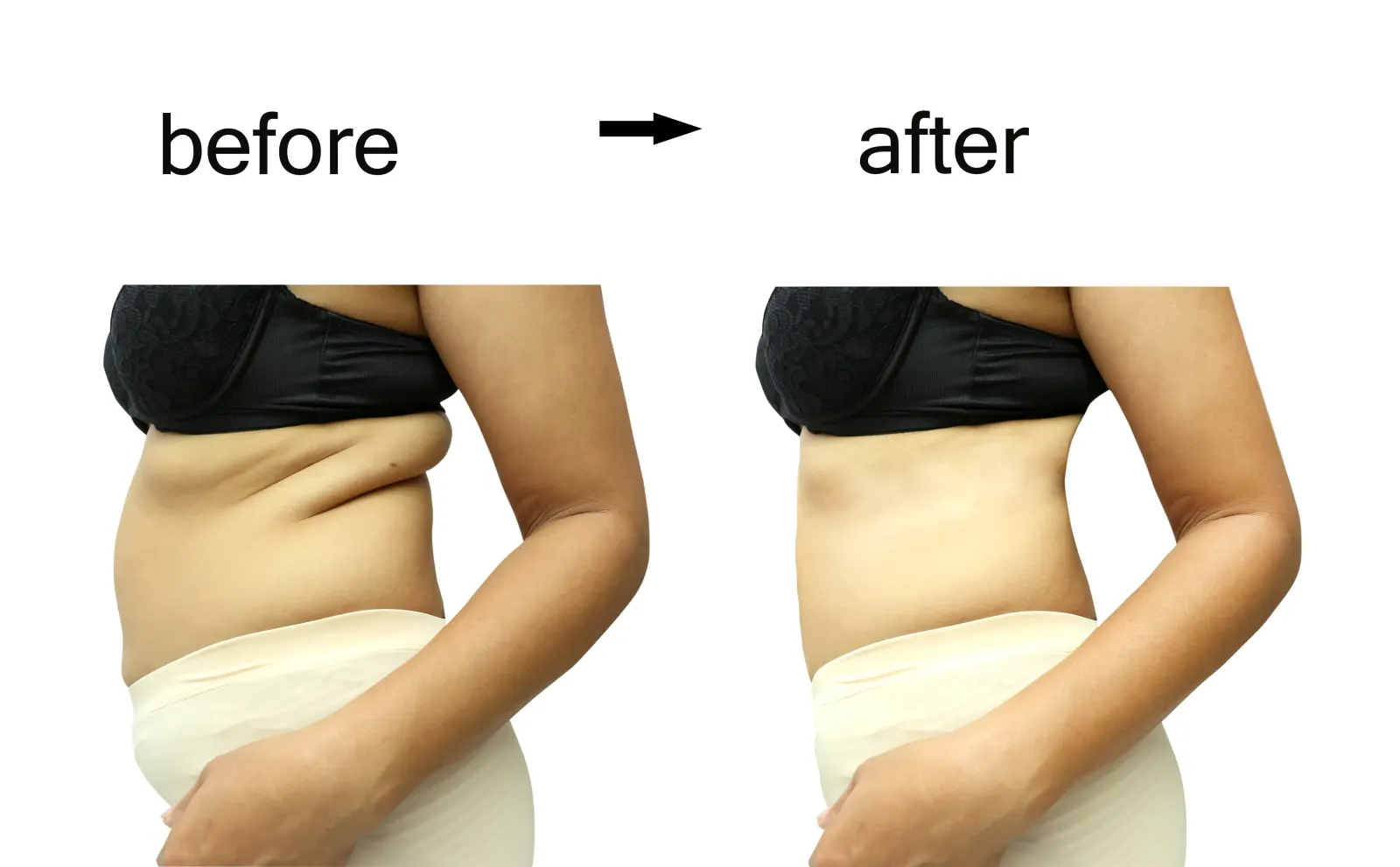 Side-view before and after of a slimmer waistline from lipotropic weight loss treatment